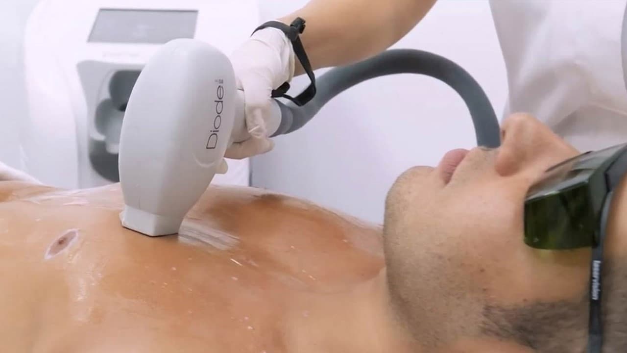 Laser hair reduction