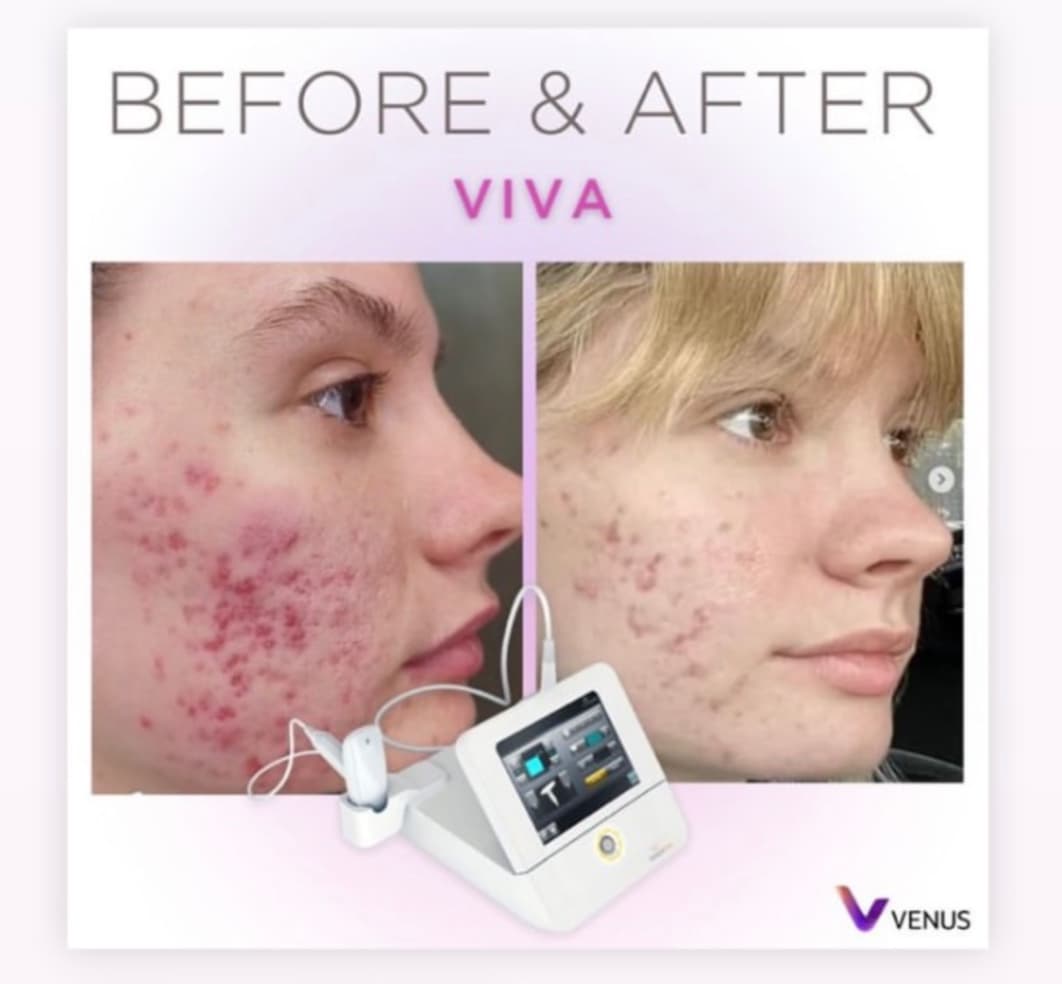 Venus Viva RF — image 4