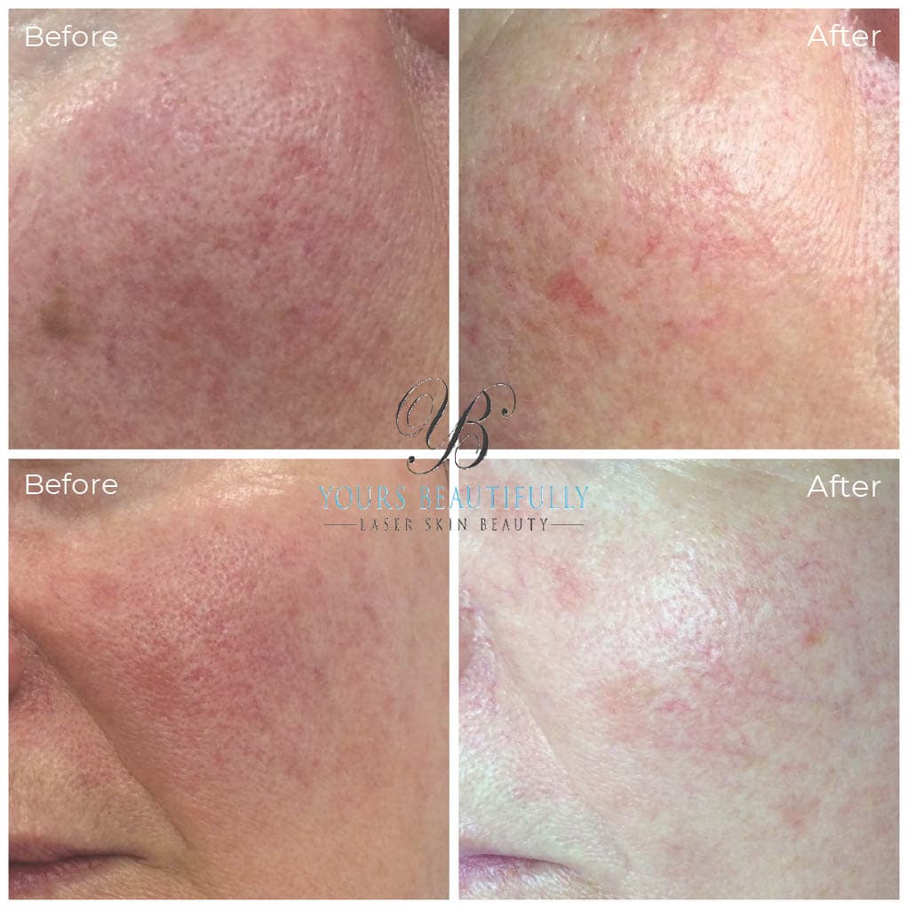Fotona Starwalker Skin rejuvenation