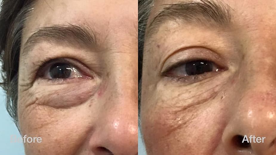 Smooth Eye Treatment