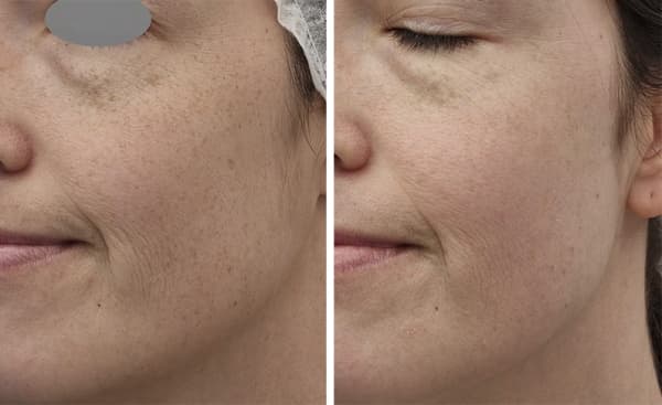 Fotona 4Glow Face prejuvenation and rejuvenation