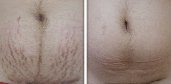 LineLase™ Stretch Mark Treatment