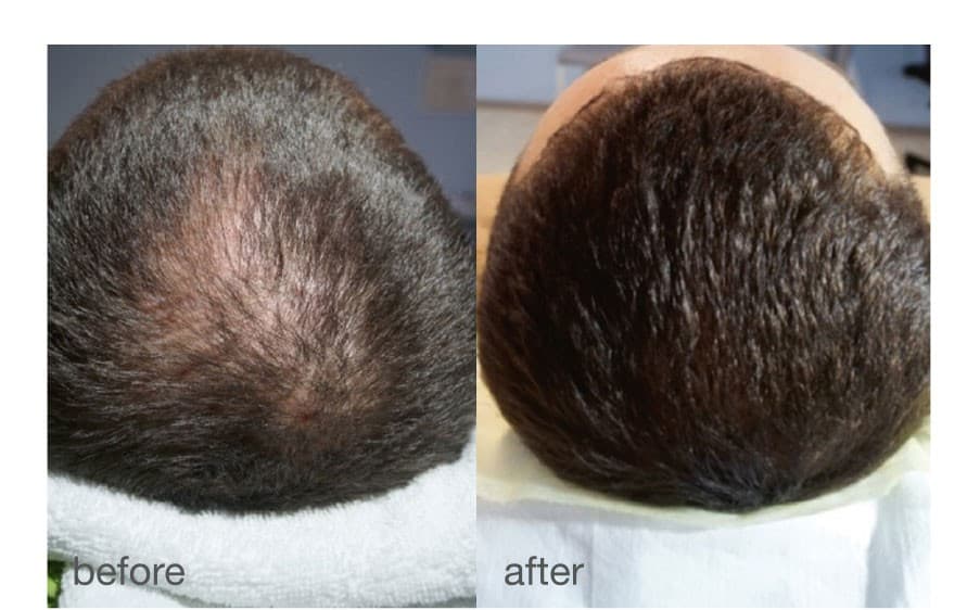 HAIRestart® Laser Hair Growth Stimulation
