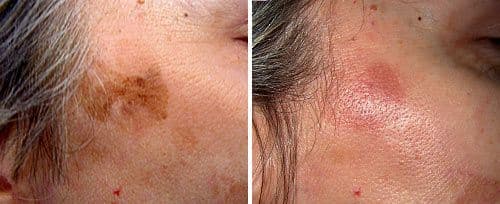 Freckles, Pigmented Lesions & General Pigmentation