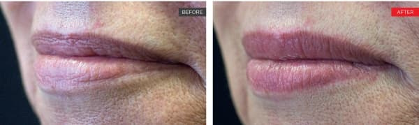 LipLase® Laser Lip Plumping & Rejuvenation