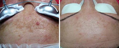 Gold Diamond Tone Up PhotoBooster — Melasma & Pigmentation