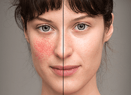 Rosacea Laser Treatment