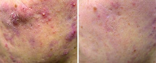 Active Acne Laser Treatment