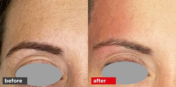 VectorLift® Laser Brow & Upper Eyelid Rejuvenation