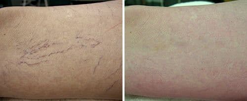 Capillaries, Veins & Cherry Angioma Removal