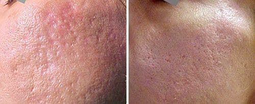 Acne Scar & Scar Management