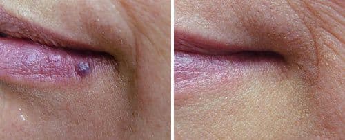 Capillaries, Veins & Cherry Angioma Removal — image 2