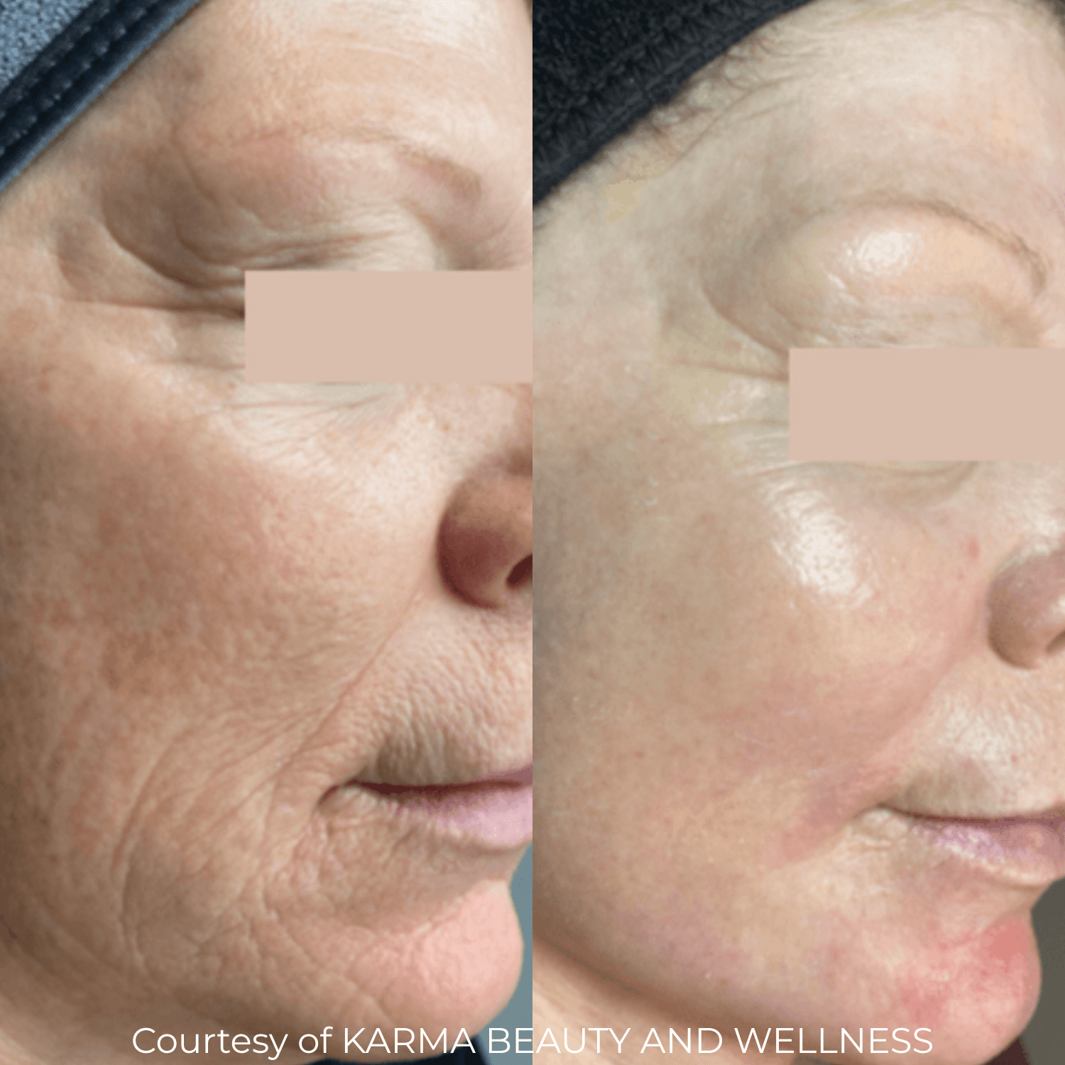 CoolPeel® CO₂ Laser (Full Face and Décolletage) — image 8