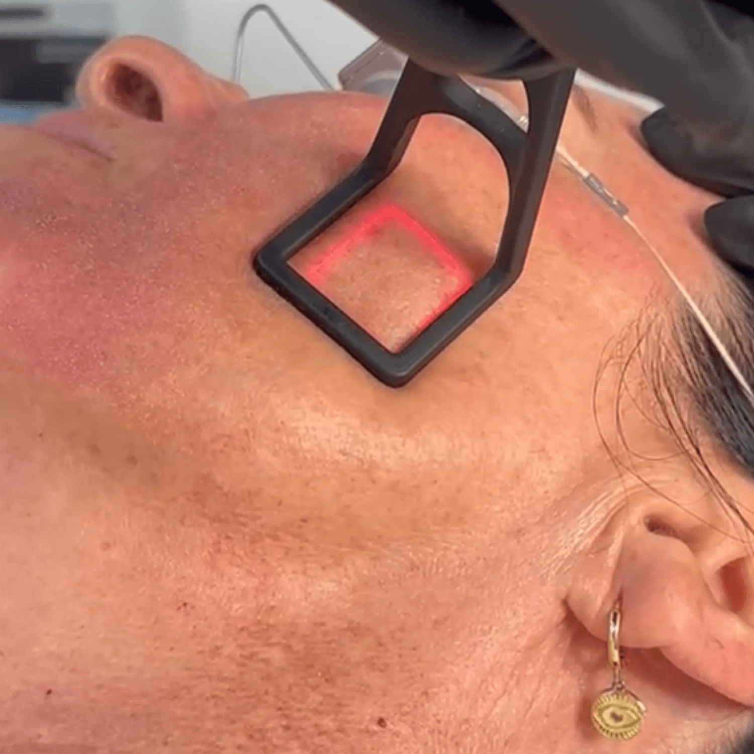 CoolPeel® CO₂ Laser (Full Face and Décolletage) — image 6