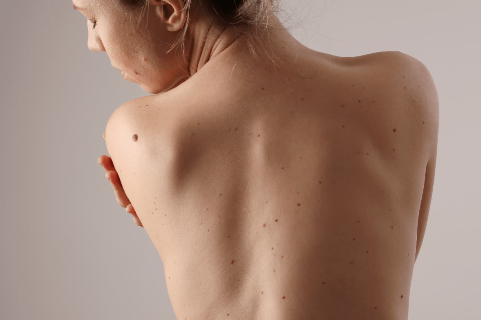 Pigmented Lesions