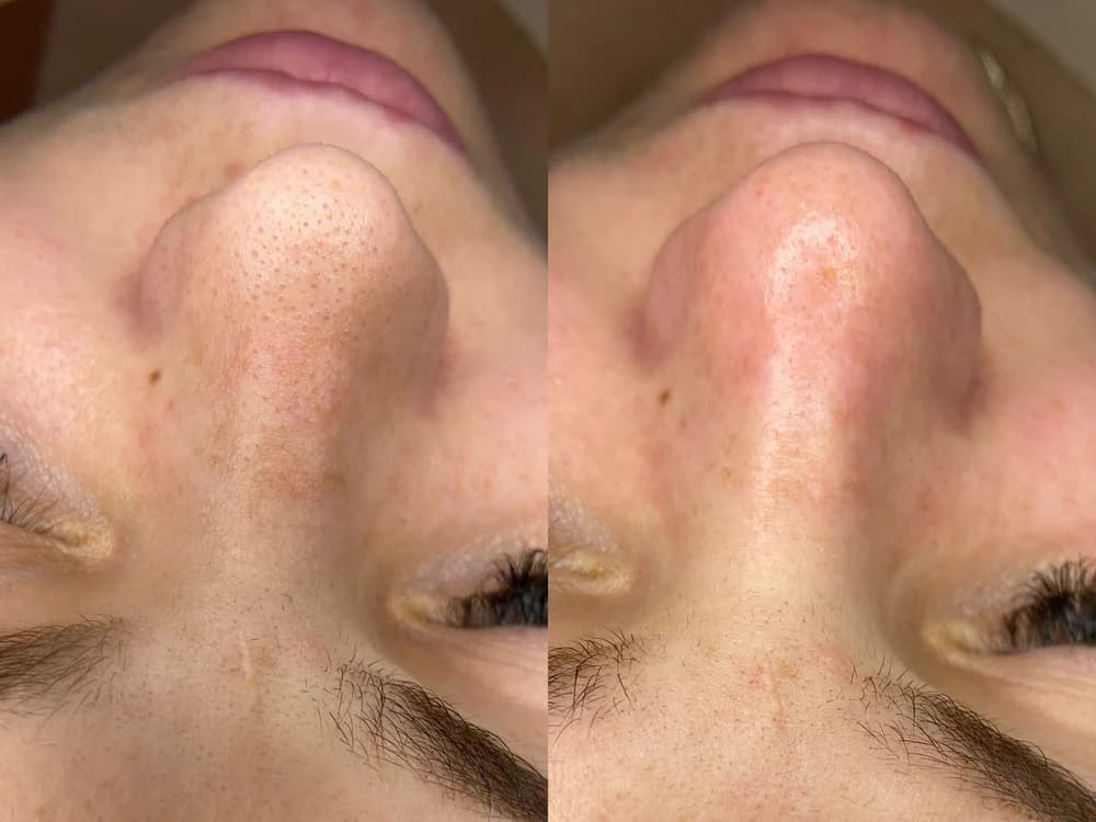 Hydrafacial