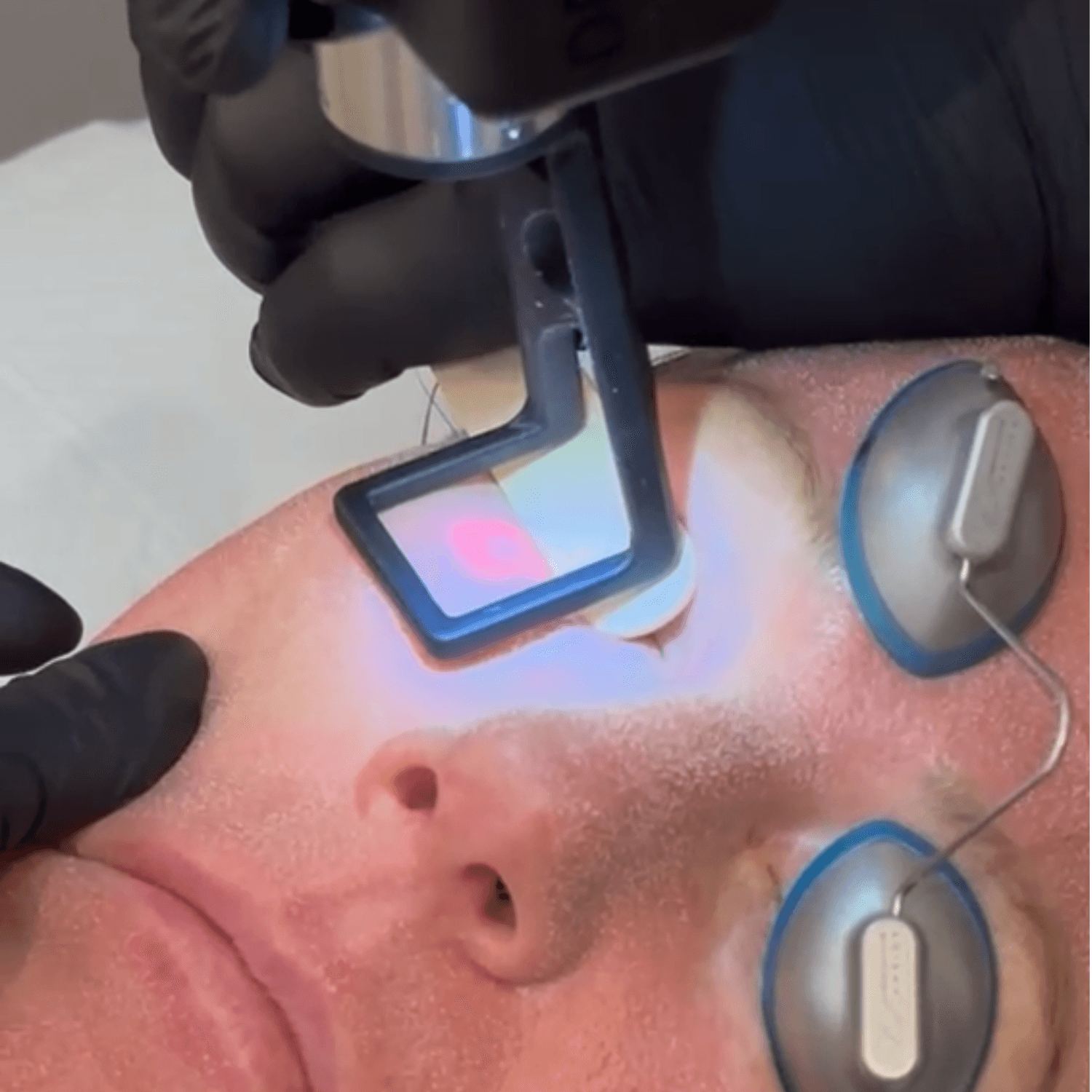 CoolPeel® CO₂ Laser (Full Face and Décolletage) — image 5