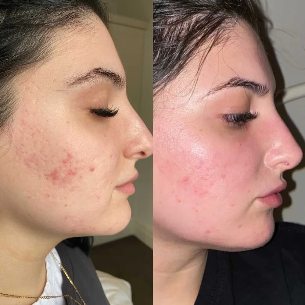 DoubleTite RF Microneedling