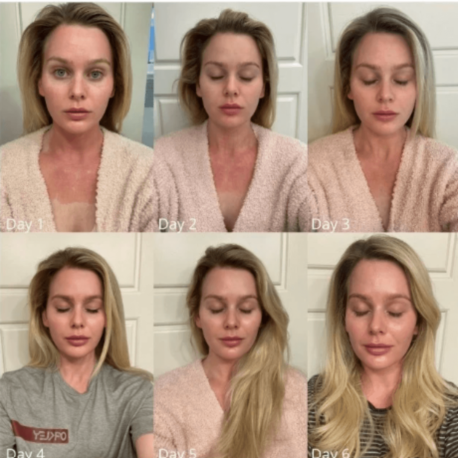 DOT CO₂ Skin Resurfacing (Full Face and Neck) — image 7