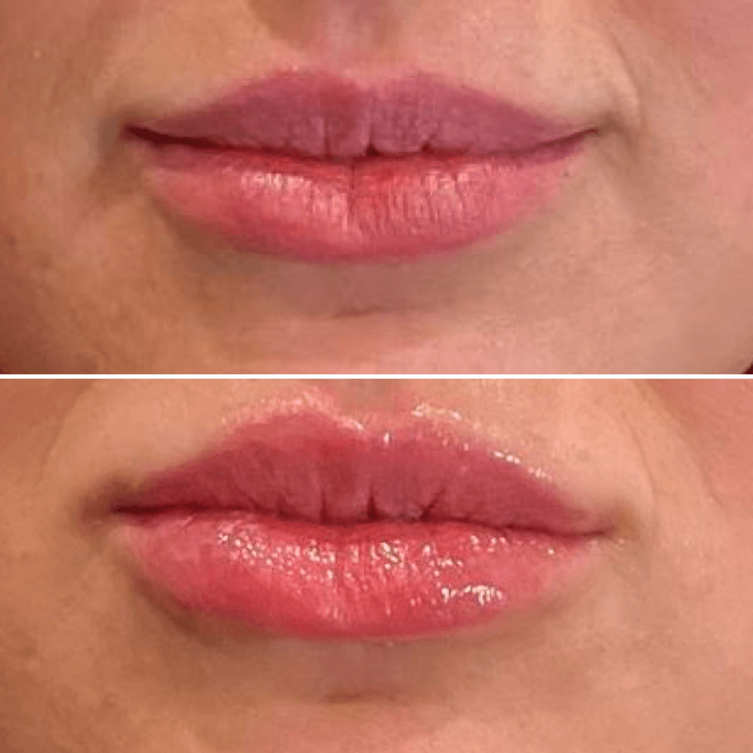 Hydrafacial Deluxe — image 3