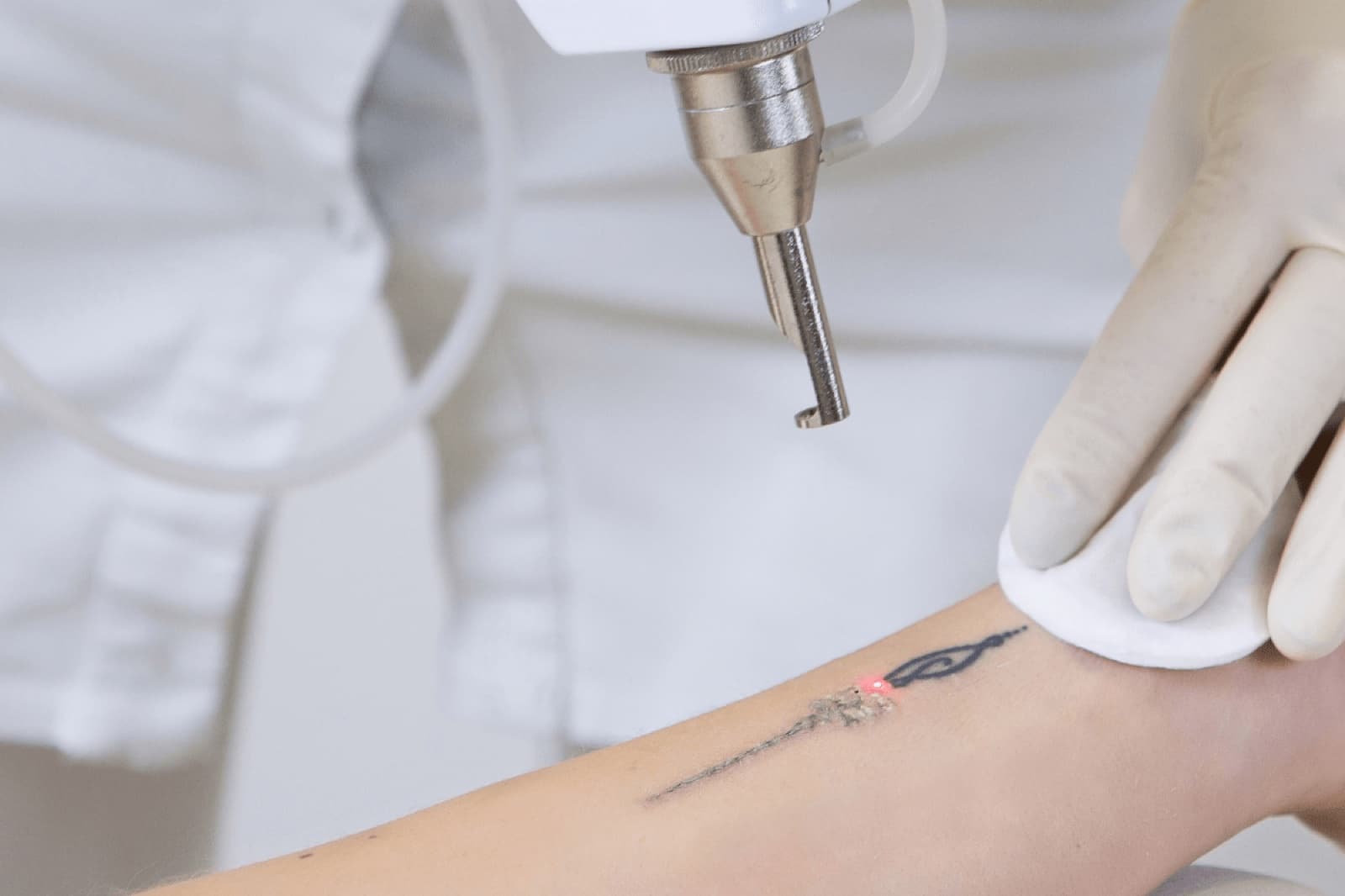 Tattoo Removal