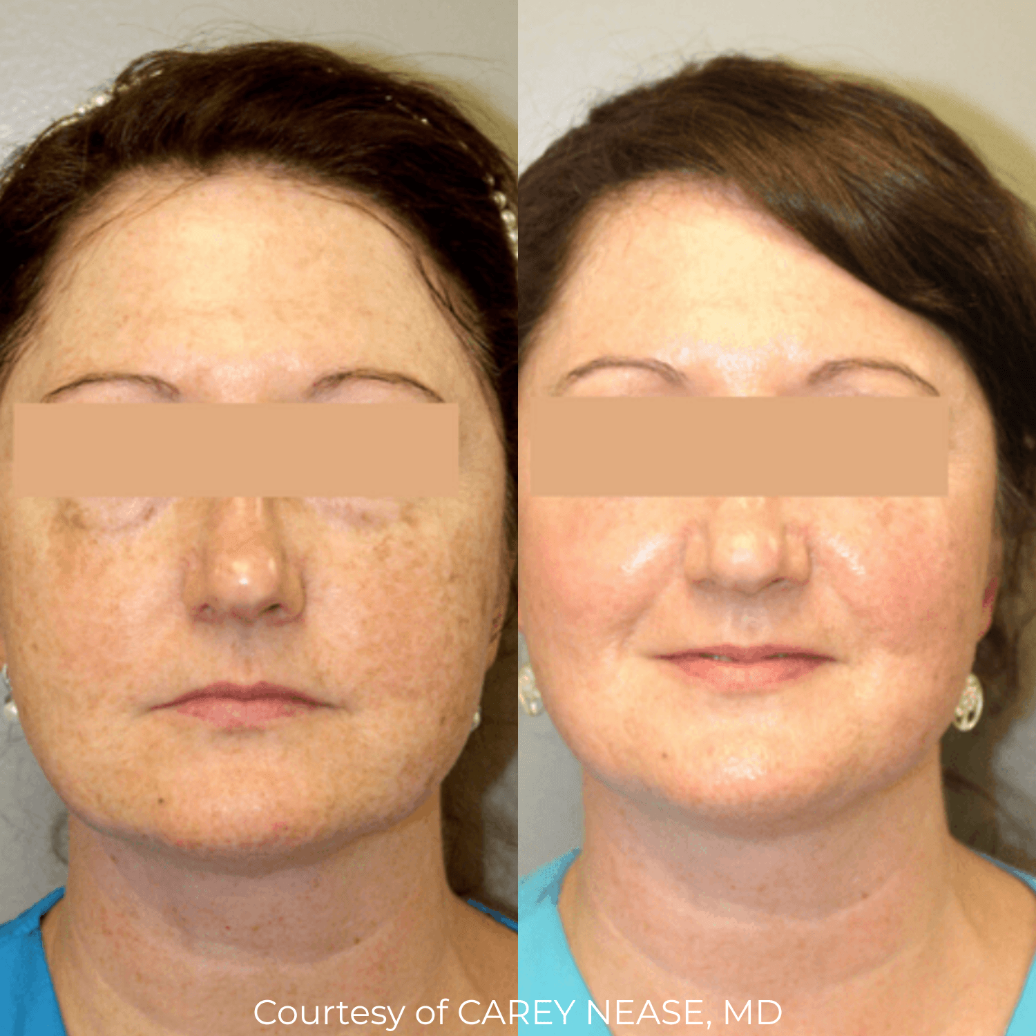 DOT CO₂ Skin Resurfacing (Full Face and Décolletage) — image 5
