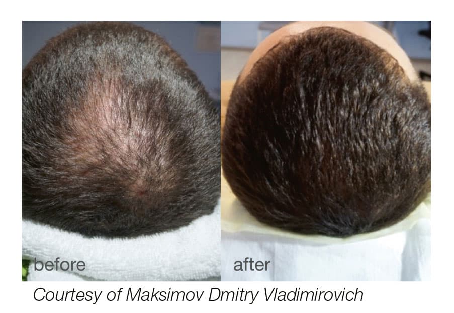 Fotona Laser HAIRestart - Hair Restoration