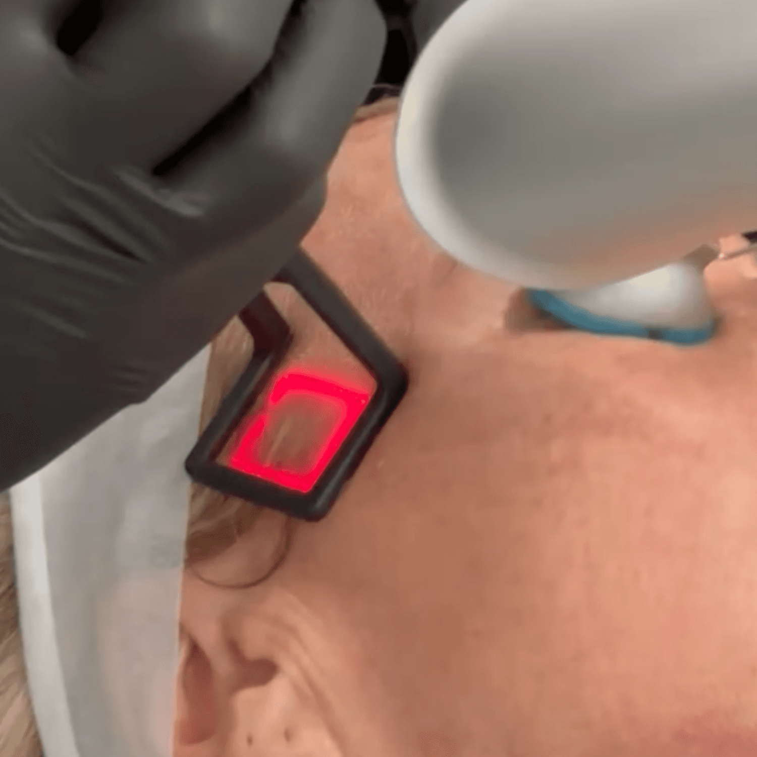 DOT CO₂ Skin Resurfacing (Full Face and Décolletage) — image 6