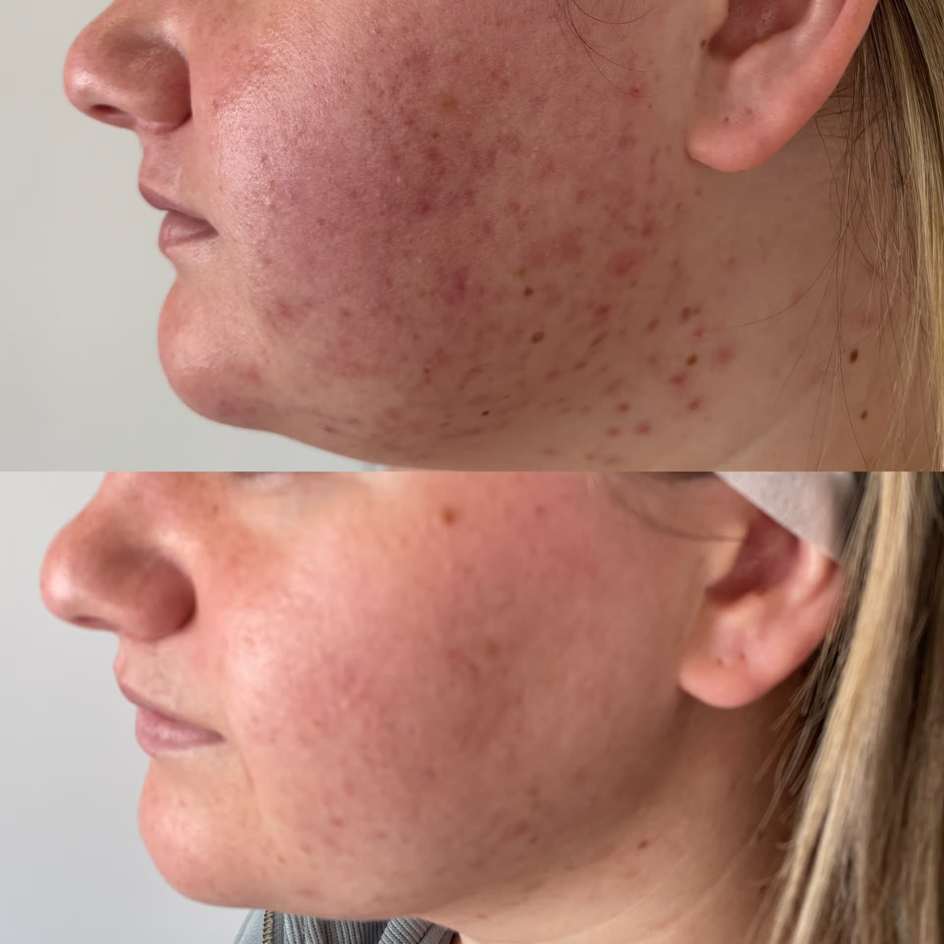 Aerolase Neo Elite - Rejuvenation & Tightening — image 2