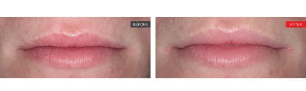 Fotona Laser LipLase - Lip Rejuvenation