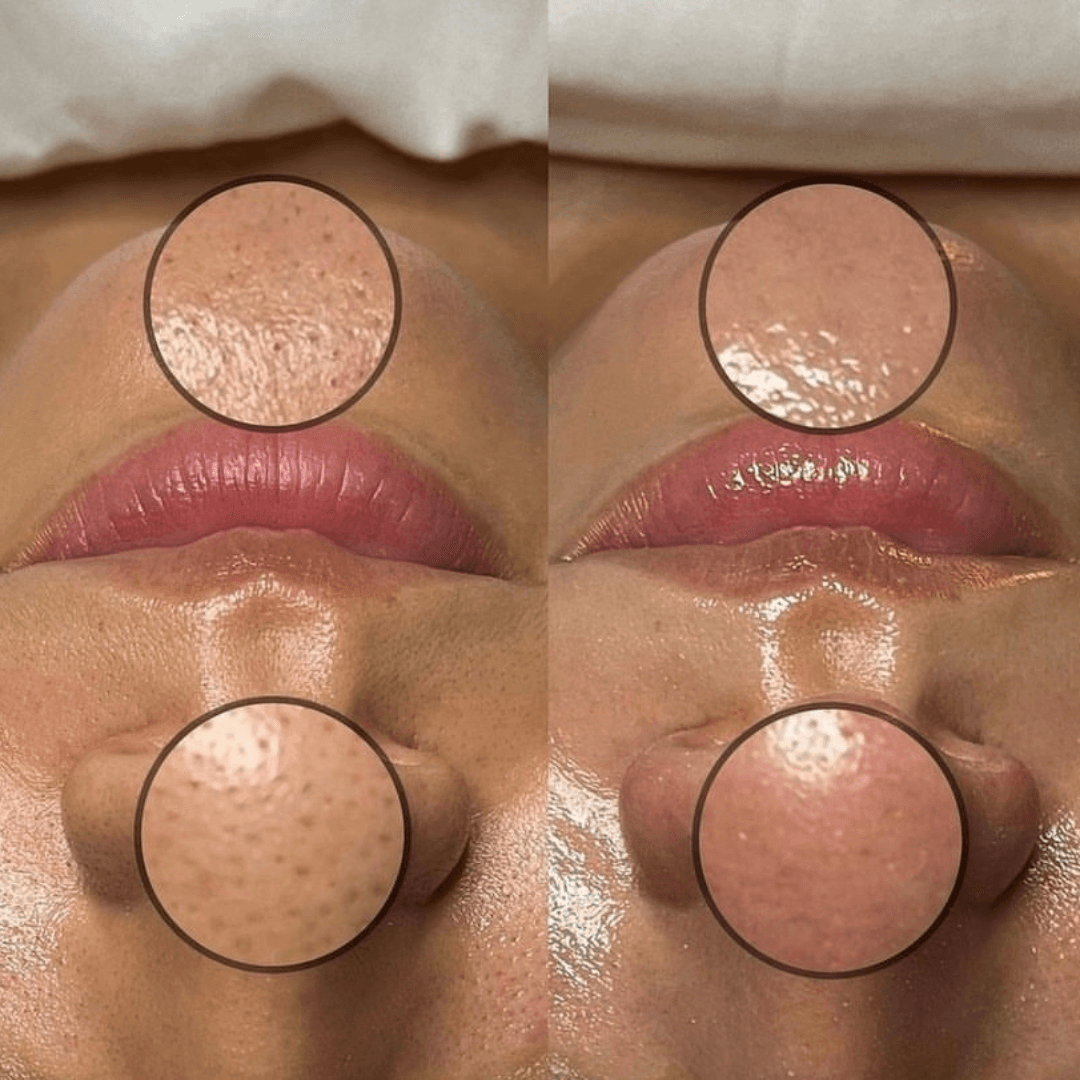 Hydrafacial Deluxe — image 7