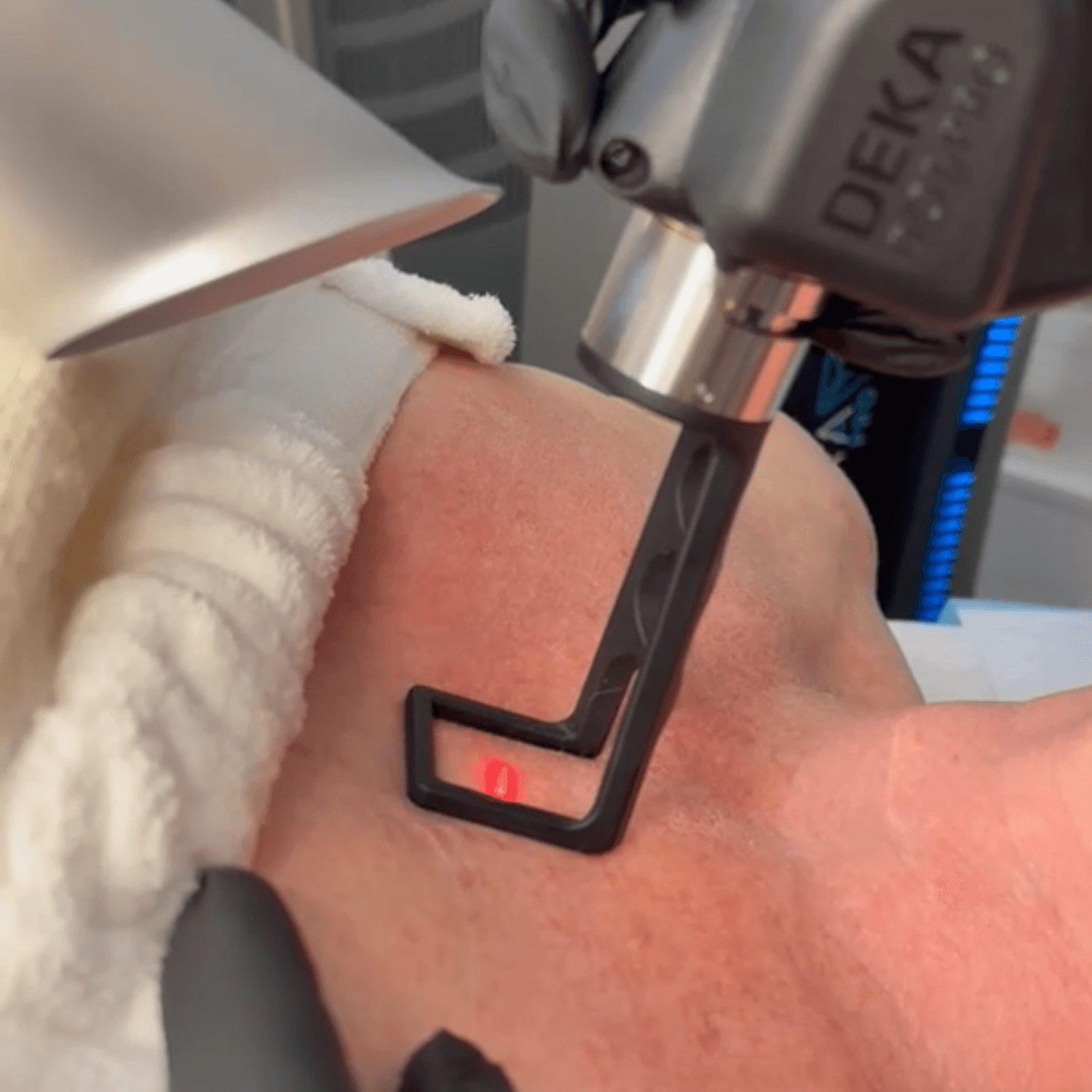DOT CO₂ Skin Resurfacing (Full Face and Décolletage)