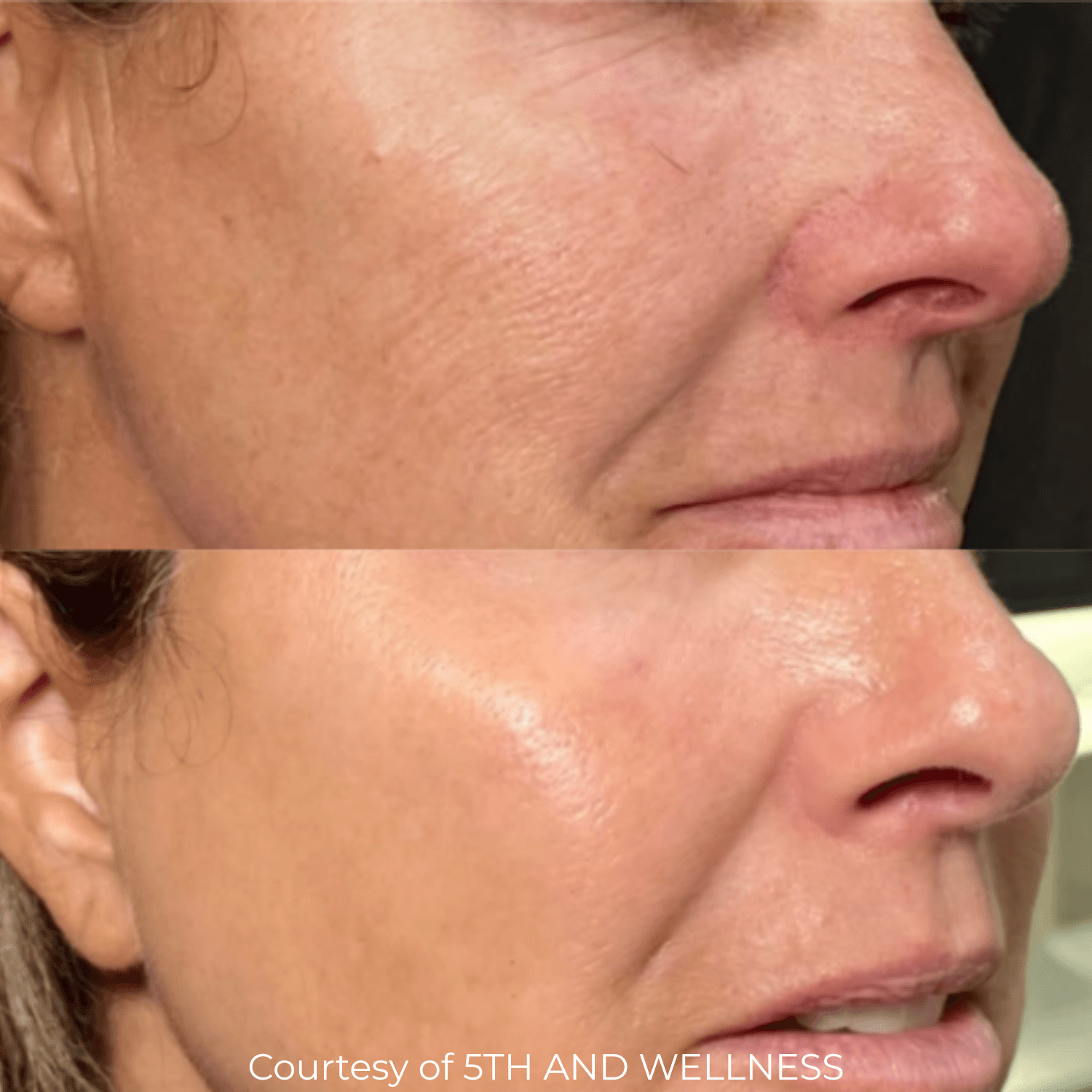 CoolPeel® CO₂ Laser (Full Face and Décolletage) — image 4