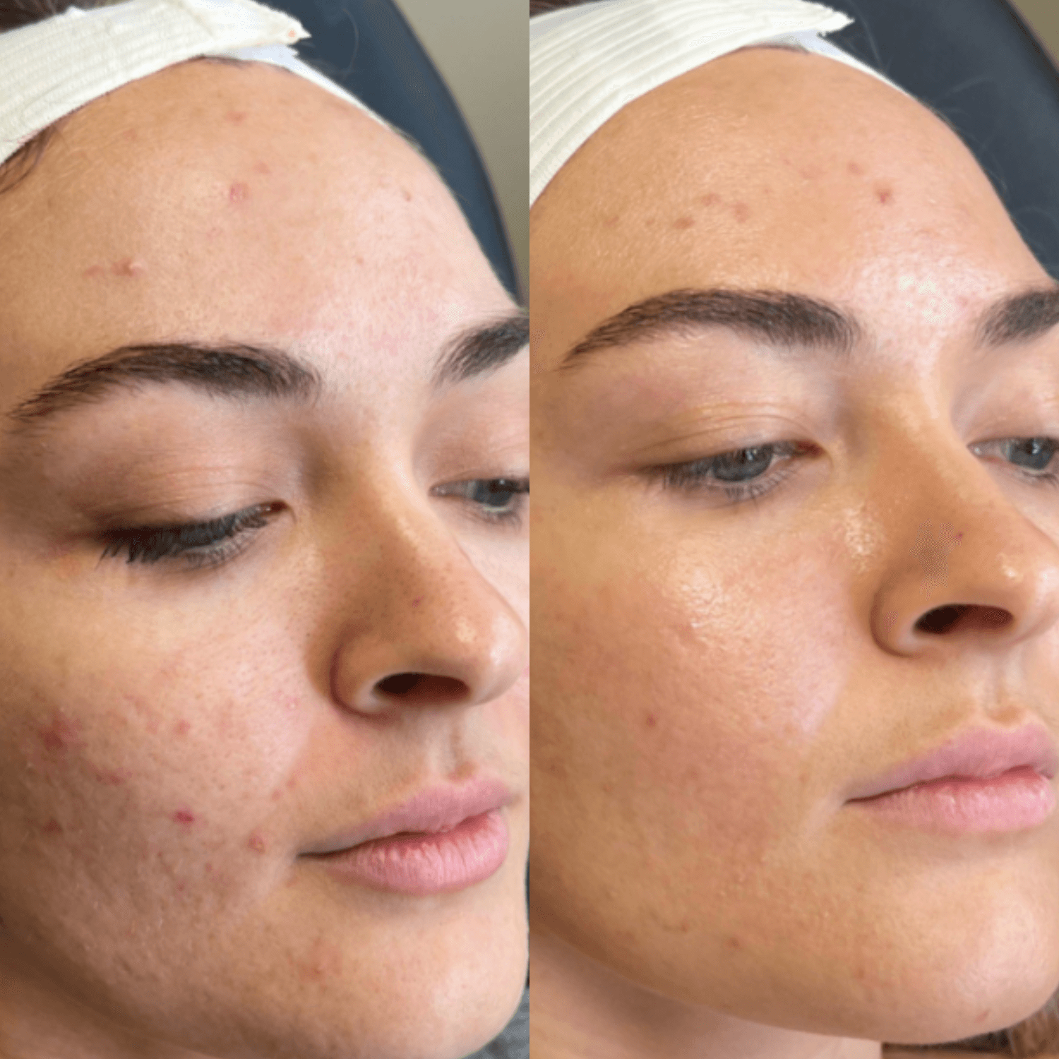 CoolPeel® CO₂ Laser (Full Face and  Neck) — image 2
