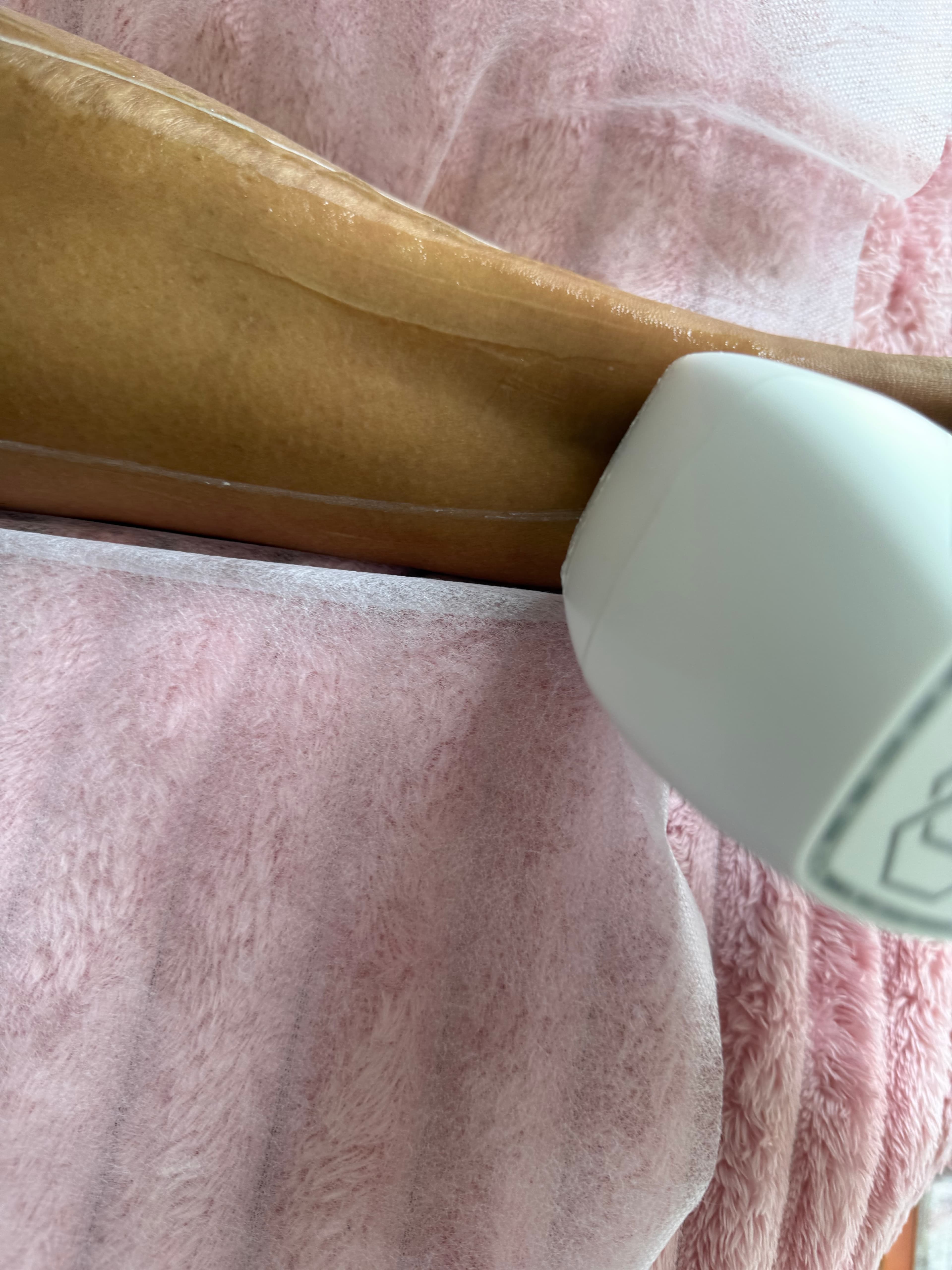 Hair Removal