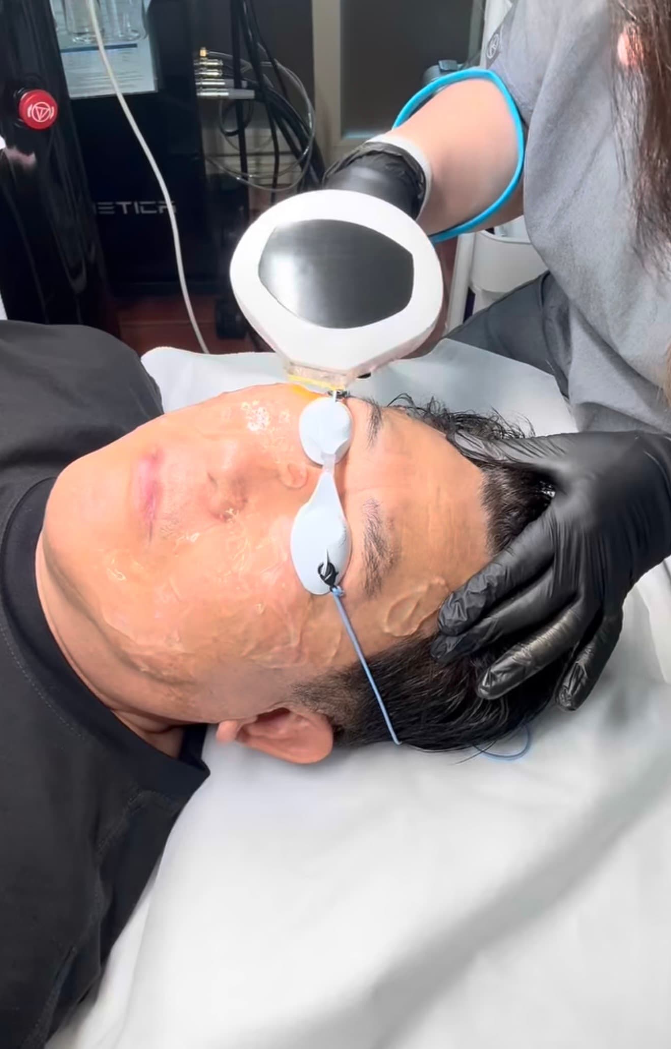 IPL Lumecca - Skin Rejuvenation