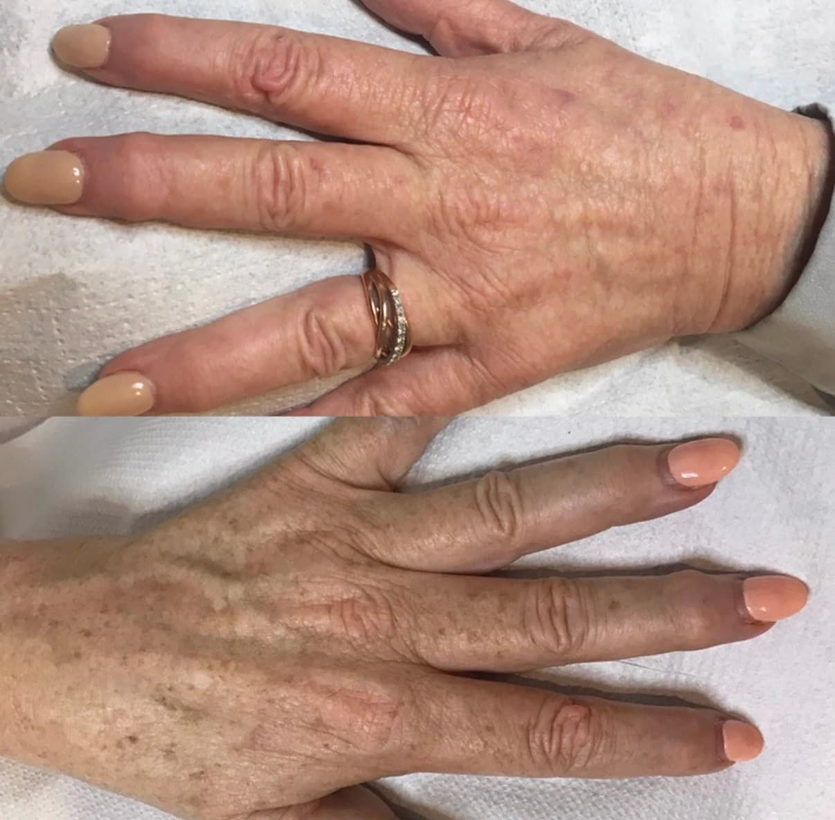 IPL Skin Rejuvenation — image 3