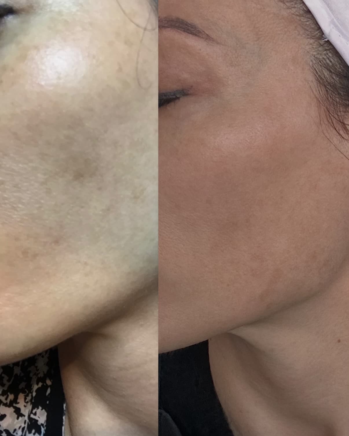 IPL Skin Rejuvenation — image 4
