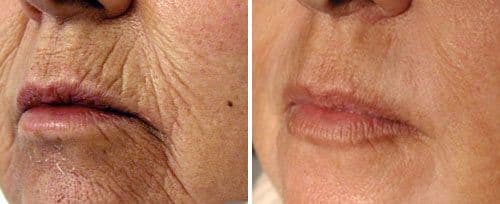 Fotona Laser Peel — Light/Medium