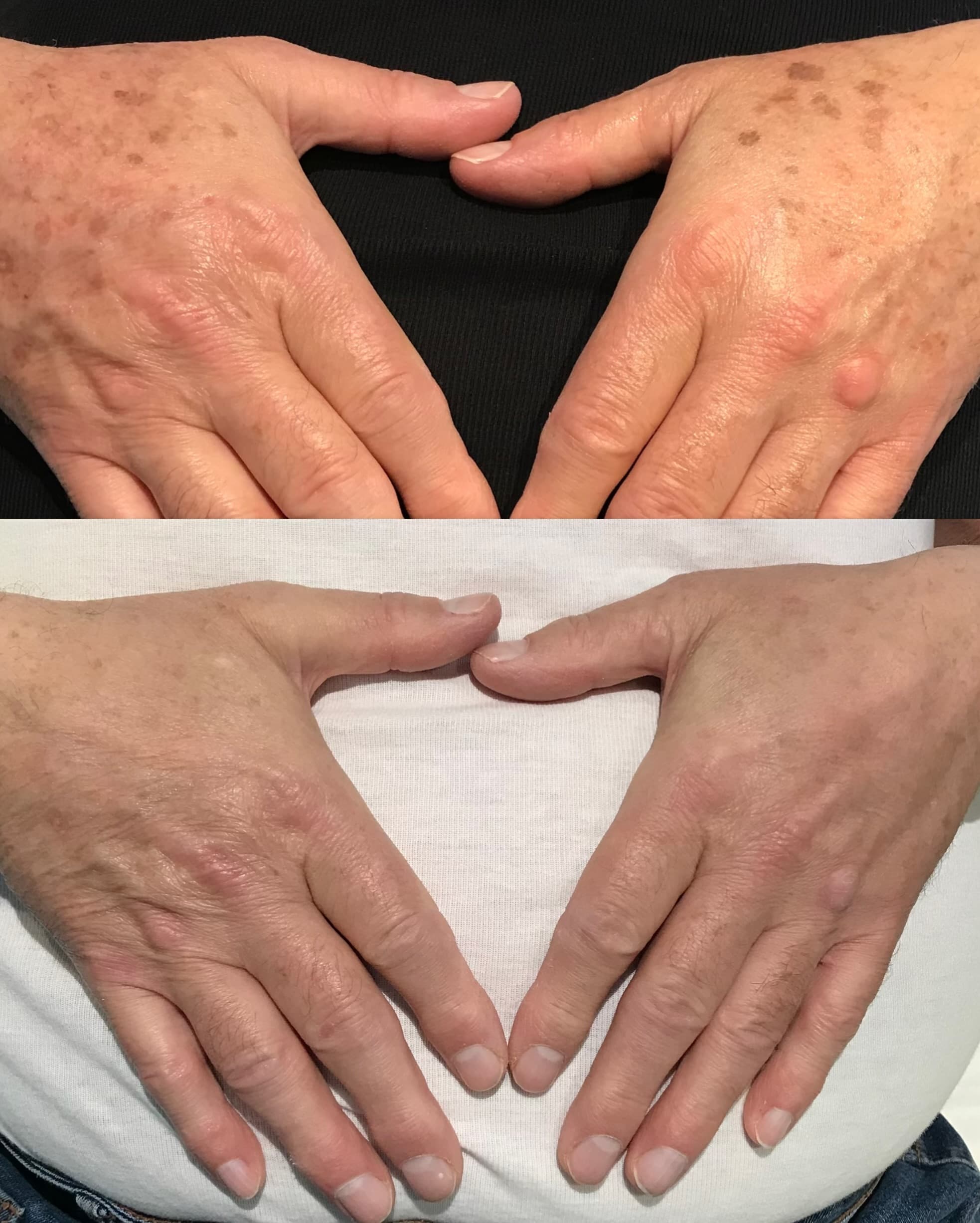 IPL Skin Rejuvenation — image 5