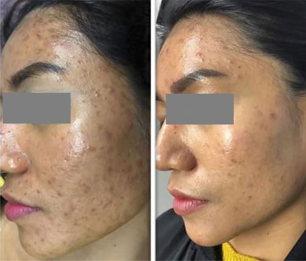 FracREVIVE rejuvenation - Skin rejuvenation