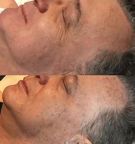 IPL Skin Rejuvenation