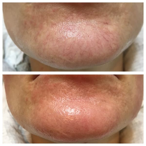 IPL Skin Rejuvenation — image 2