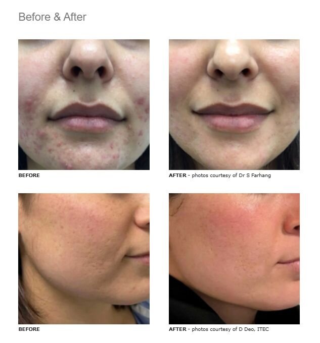 InMode Optimas Max before and after results