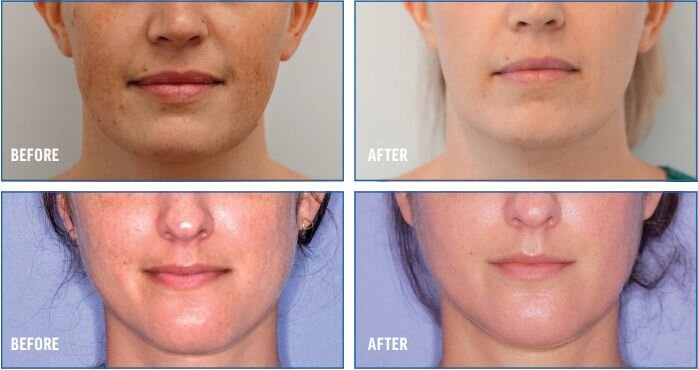 MOXI and BBL HERO before and after results